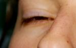 Хронический блефарит обоих глаз лечение